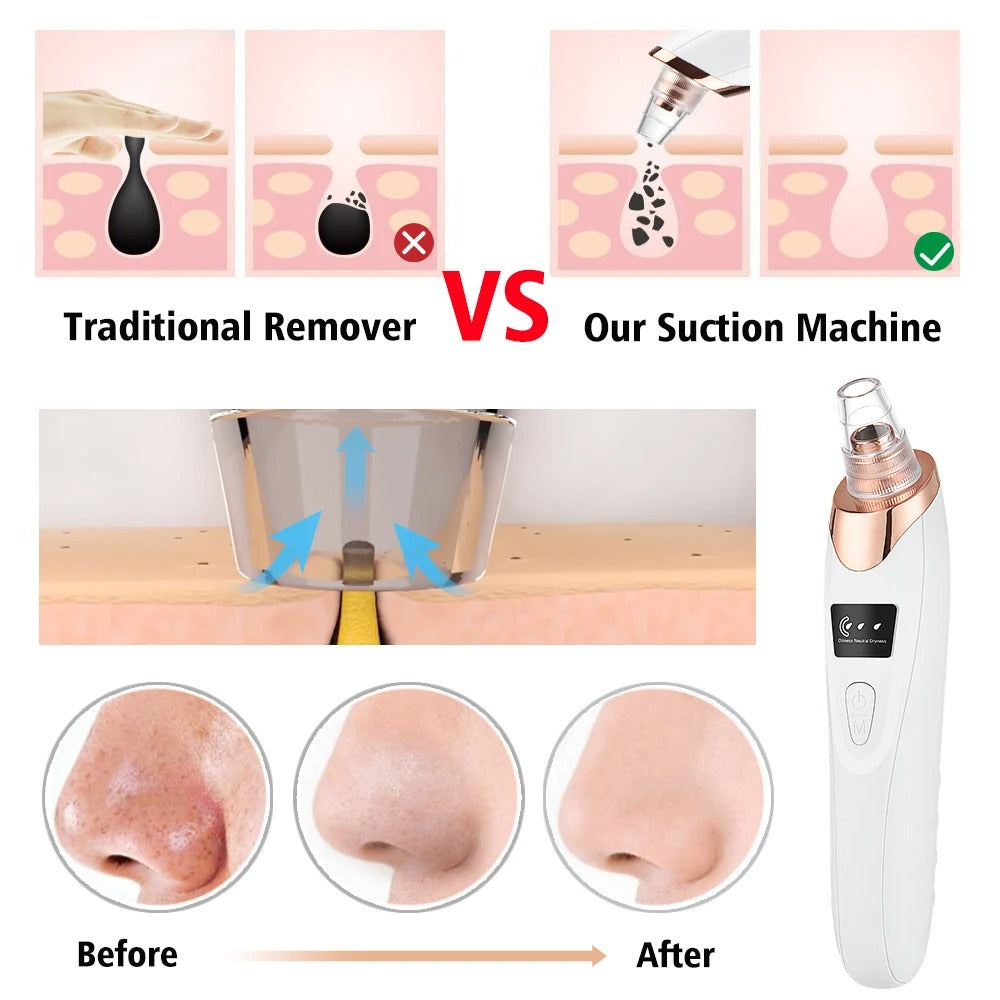 Rechargeable Portable Blackhead Vacuum – Sifat Mart Pakistan